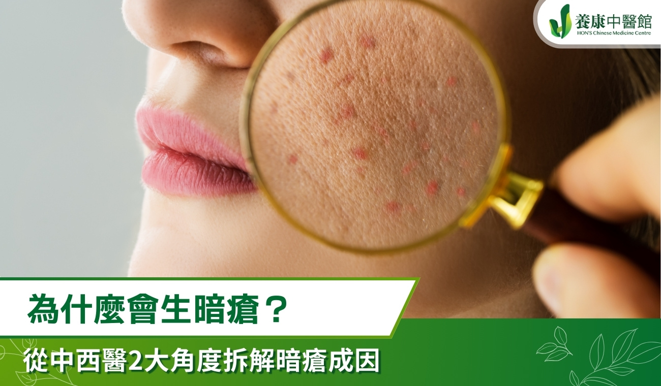 為什麼會生暗瘡？哪些人較容易生？從中西醫2大角度拆解暗瘡成因