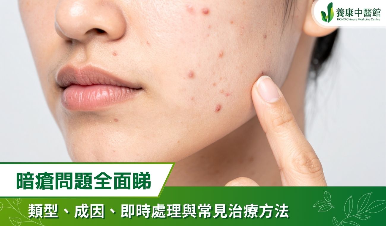 暗瘡問題全面睇：暗瘡類型、成因、即時處理與常見治療方法