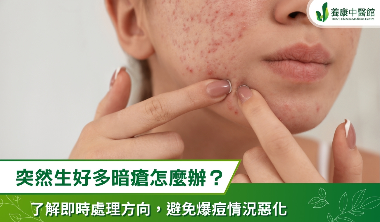 突然生好多暗瘡怎麼辦？3 個即時處理方向，避免爆痘情況惡化