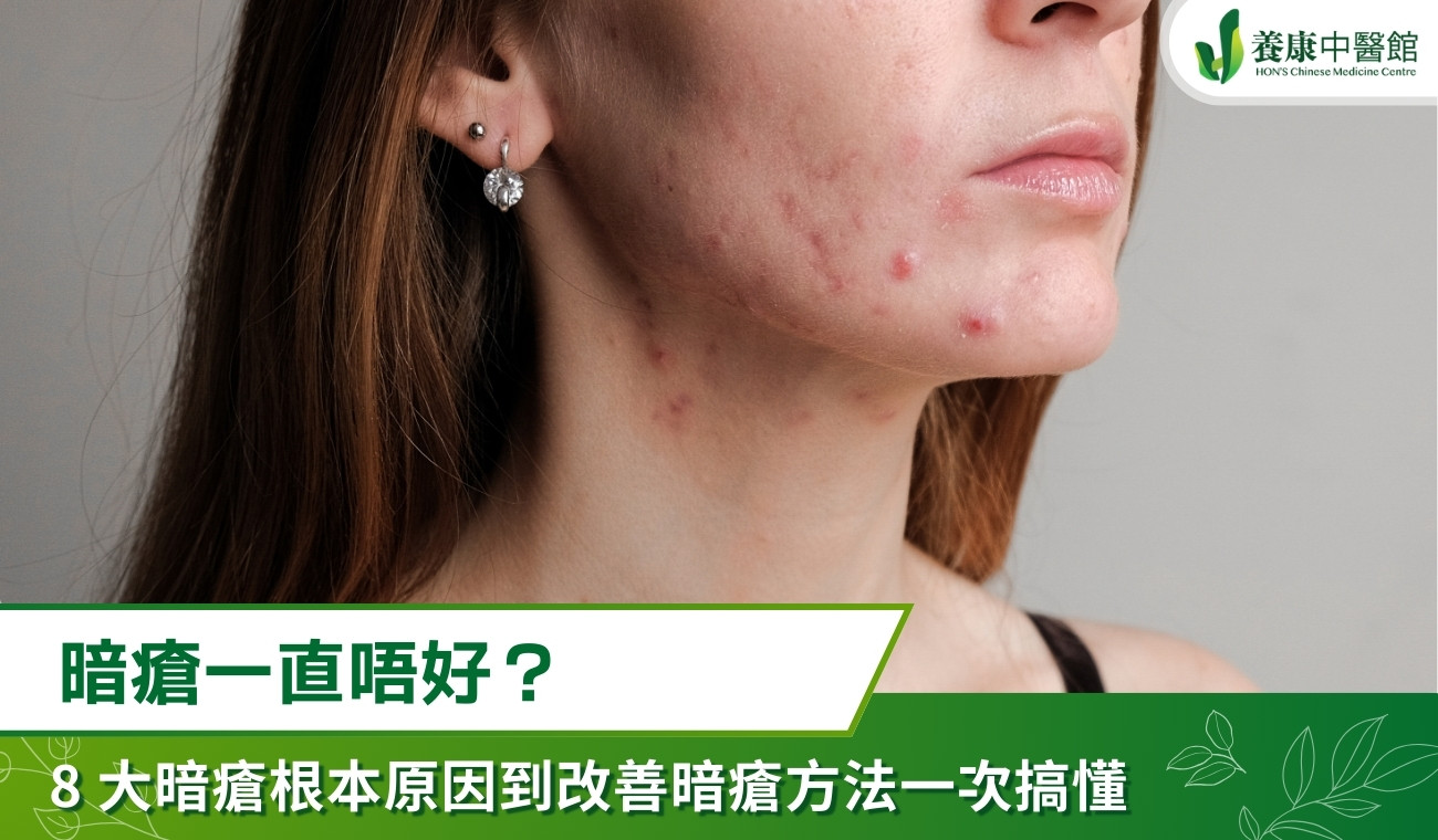 暗瘡一直唔好？8大暗瘡根本原因到改善暗瘡方法一次搞懂