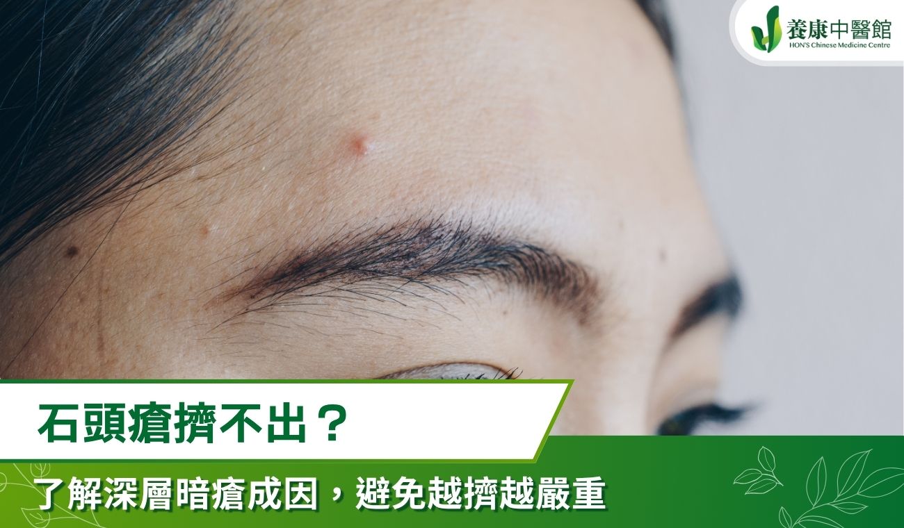 石頭瘡擠不出？了解深層暗瘡成因，避免越擠越嚴重
